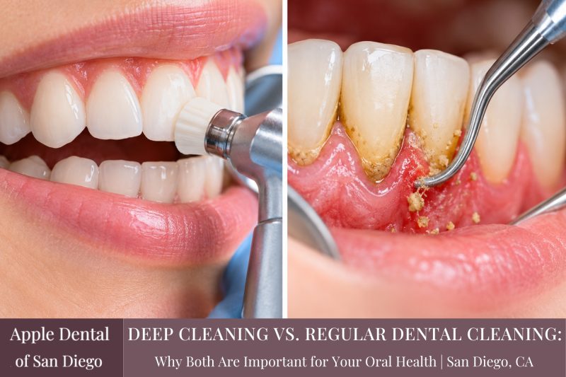 Deep Cleaning vs. Regular Dental Cleaning Why Both Are Important for Your Oral Health San Diego, CA